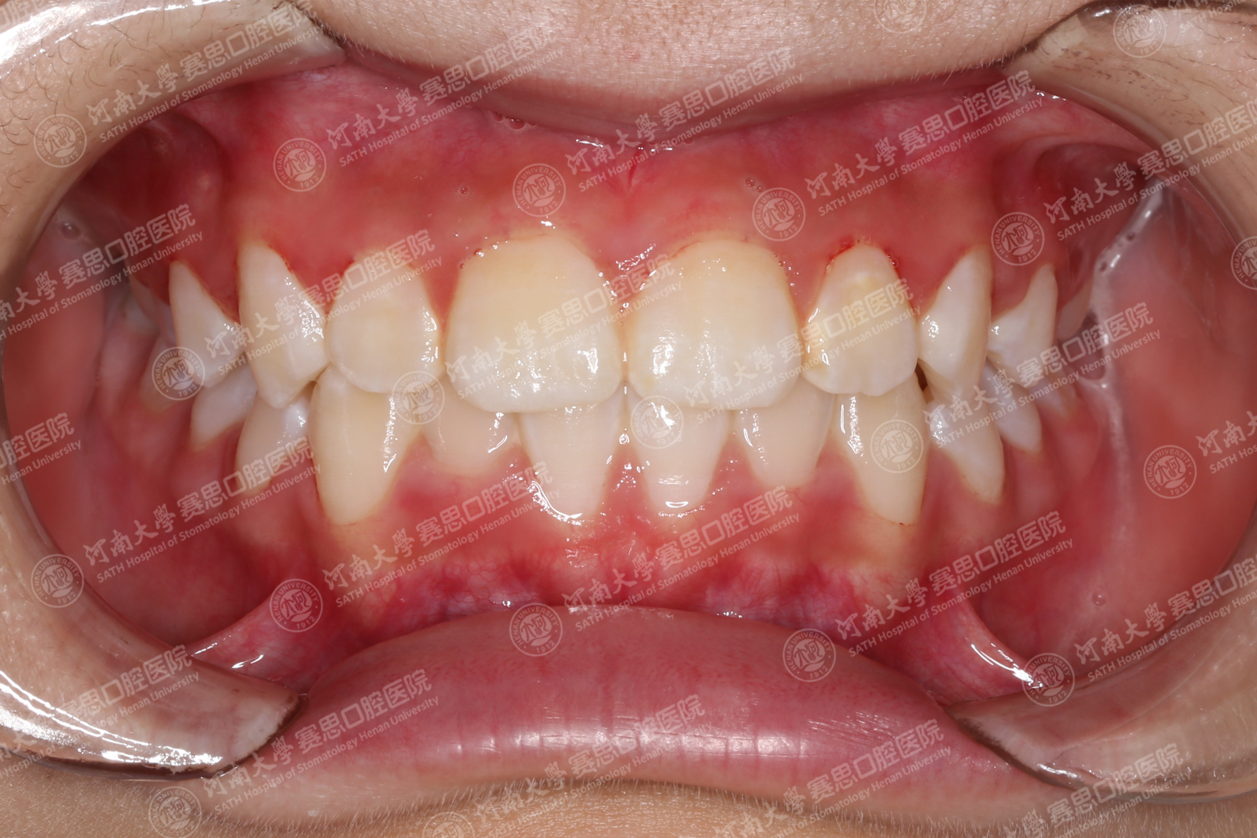 早发现早治疗，替牙期的矫正很重要