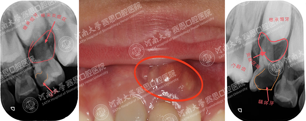 老人口中的“牙根疮”到底是什么疾病？